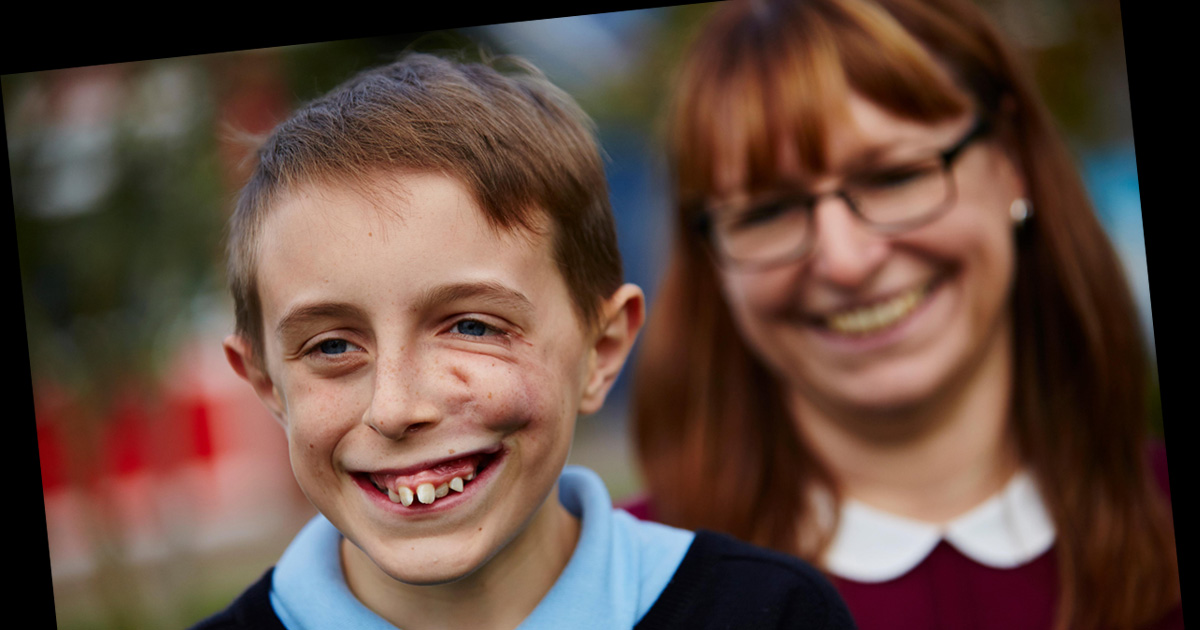 Children Who Live With Facial Disfigurement Face Severe Bullying