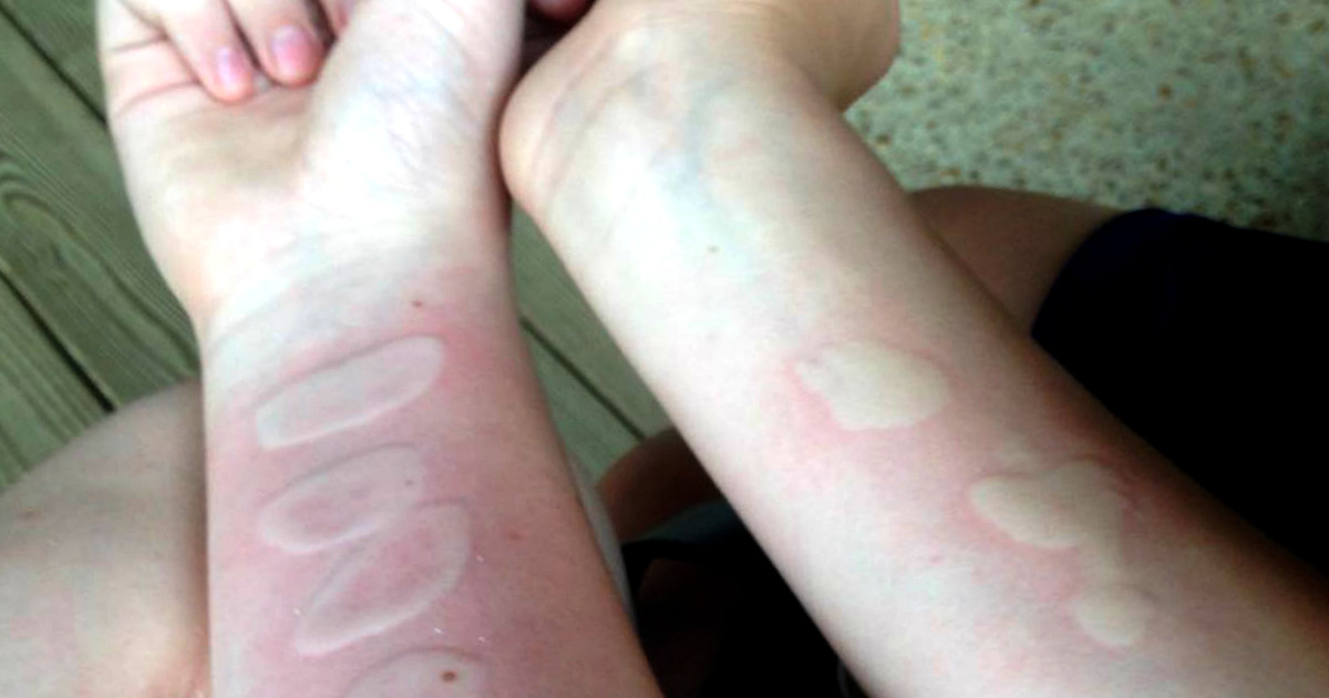 Attention Parents! The Salt And Ice Challenge Can Actually Burn Your Kids' Skin