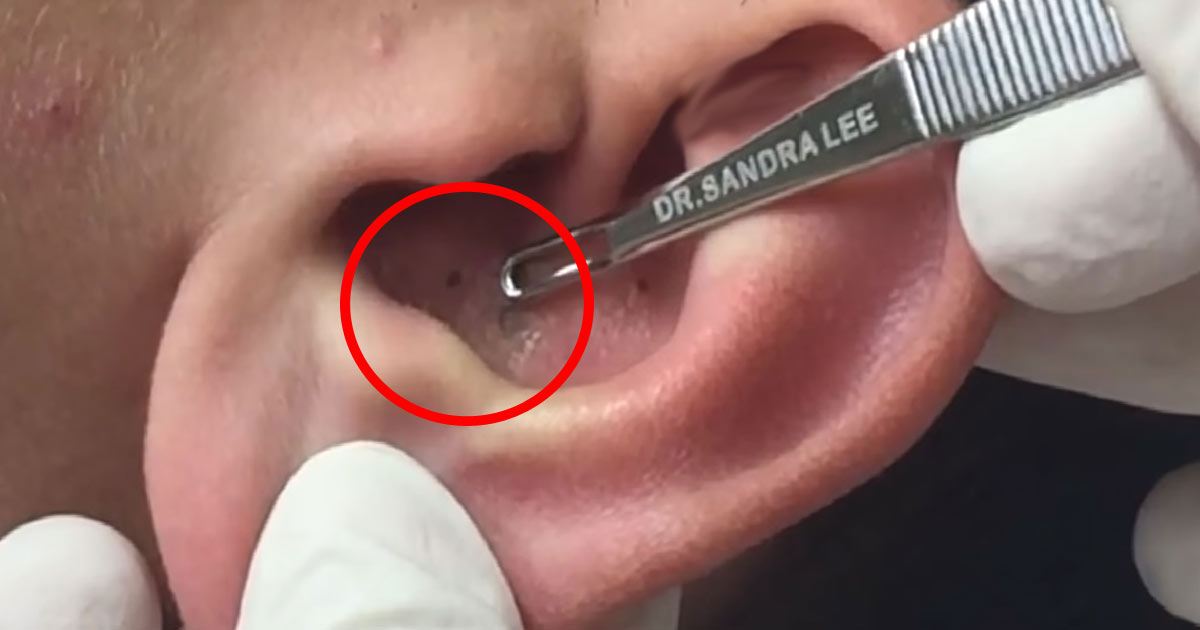 Doctor Helps Man With Pimple In His Ear In The Most Bizarre Way