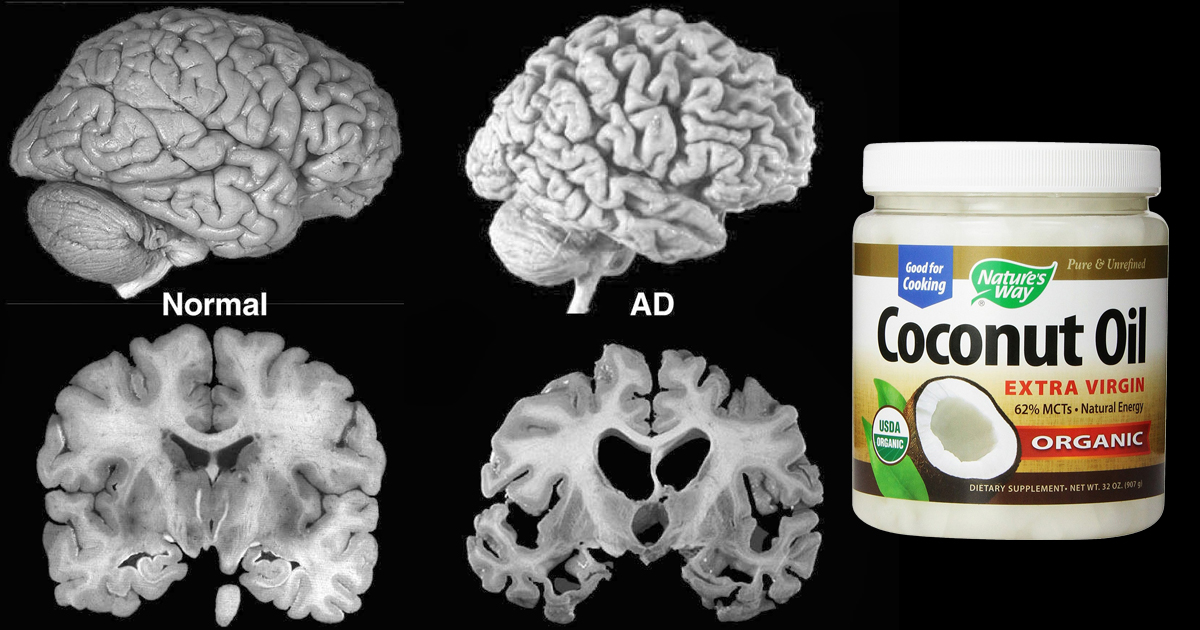 Two Spoons Of Coconut Oil A Day Can Entirely Transform Your Brain!