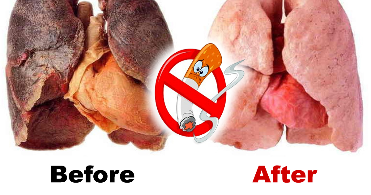 Smokers Can Cleanse Their Lungs Of Toxins With This Natural Tonic