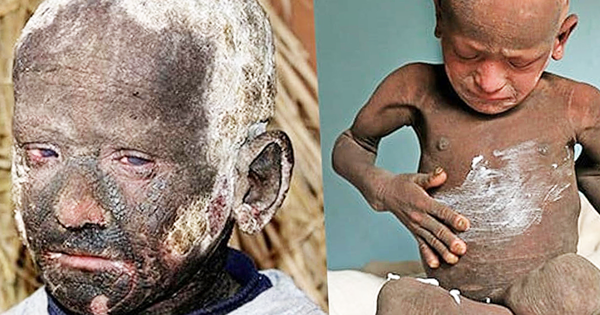 Boy Has Rare Skin Disease That Is Slowly Turning Him To Stone