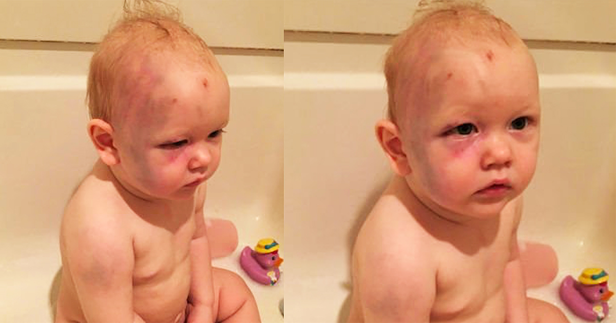 Parents Wake To Find Their Son Covered In Bruises, Then Dad Notices The Handprint On His Face