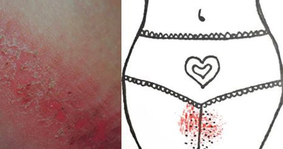 5 Brilliant Tips To Help Keep Your Thighs Chafe-Free This Summer