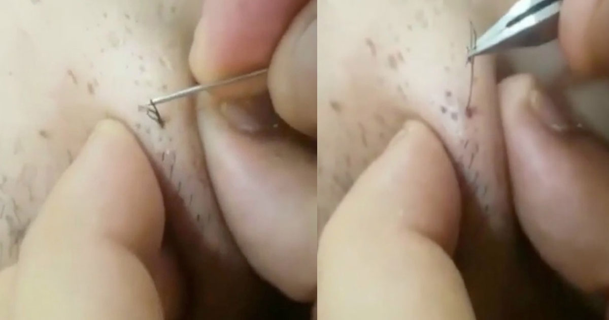 9 Important Things Every Woman Should Know About Those Painful, Embarrassing Ingrown Hairs