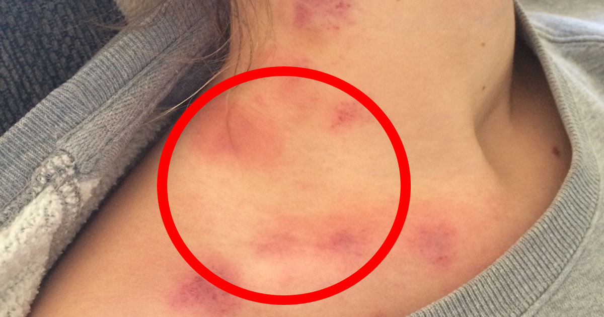 This Teen Actually Died Because Of A Hickey, Doctors Warn It’s More Common Than You Think!