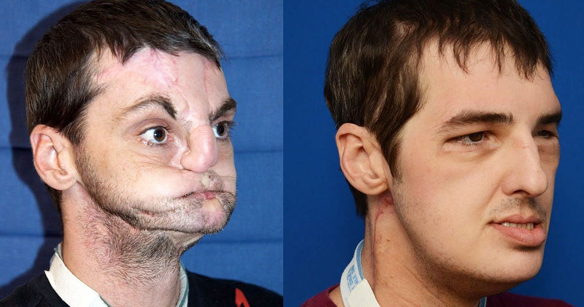 Shocking Transplants Performed On People To Give Them An Entirely New Life