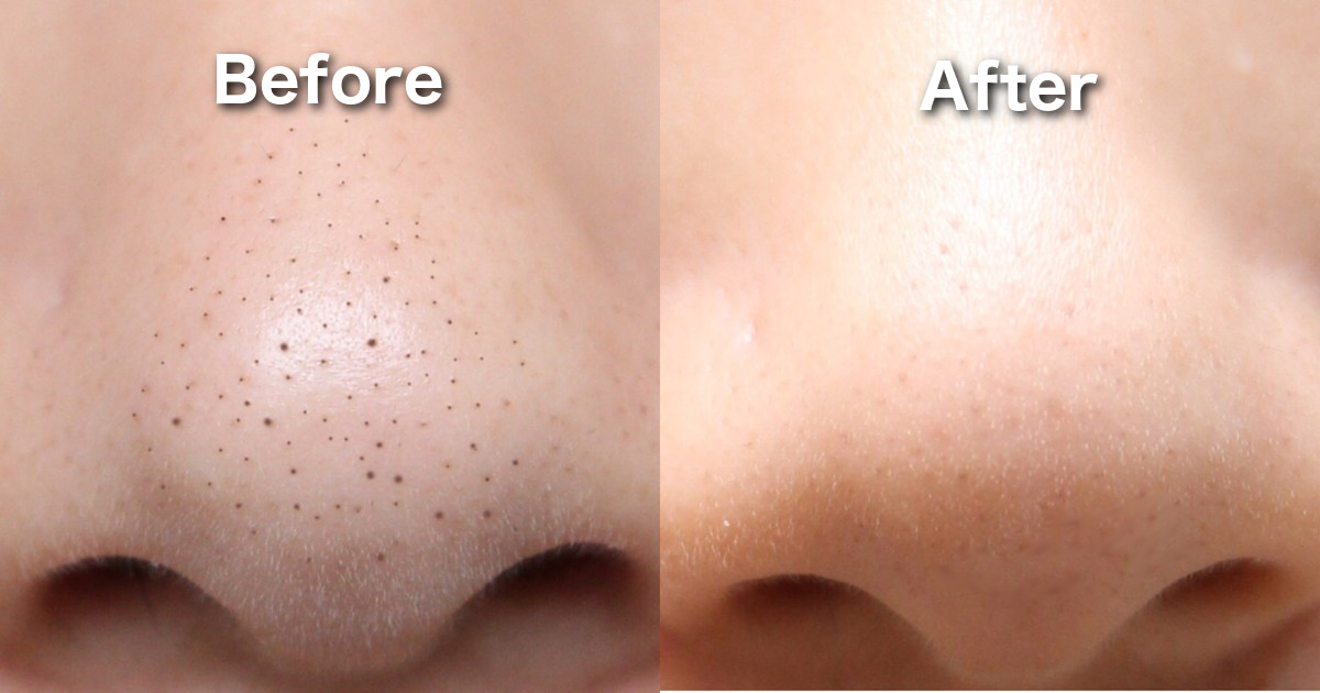 DIY At Home Treatment To Eliminate Blackheads In A Week