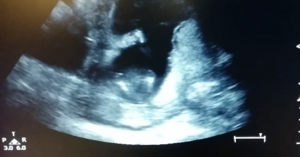 Ultrasound shows incredible baby clapping hands!